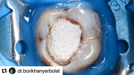 A Clinical Case by Dr. Yerbolat Borikhan with Eighteeth Ultra X and UltraMint Pro