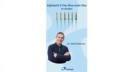 Root Canal Preparation Using Eighteeth E-FLEX BLUE Endo Files-Dr. Moh'd Hammo